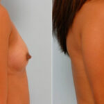 Breast Augmentation before and after photos in Houston, TX, Patient 25656
