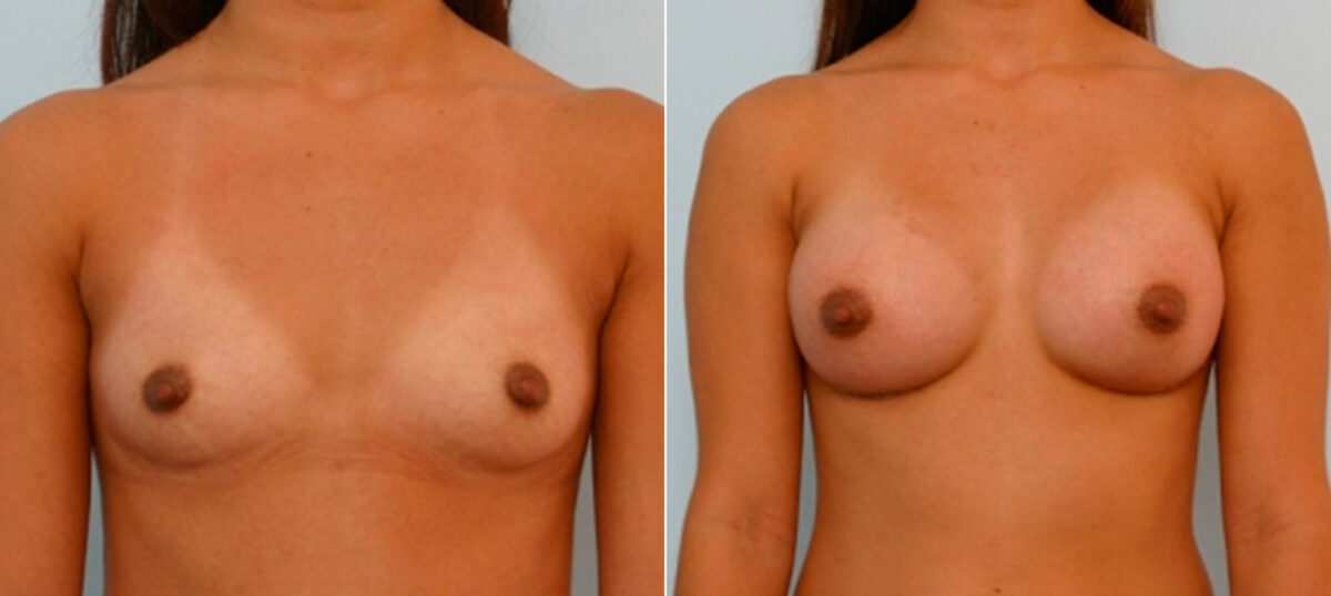 Breast Augmentation before and after photos in Houston, TX, Patient 25656