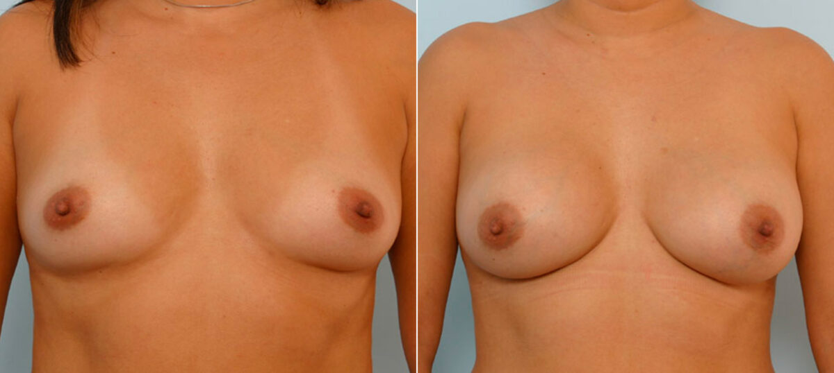 Breast Augmentation before and after photos in Houston, TX, Patient 25663