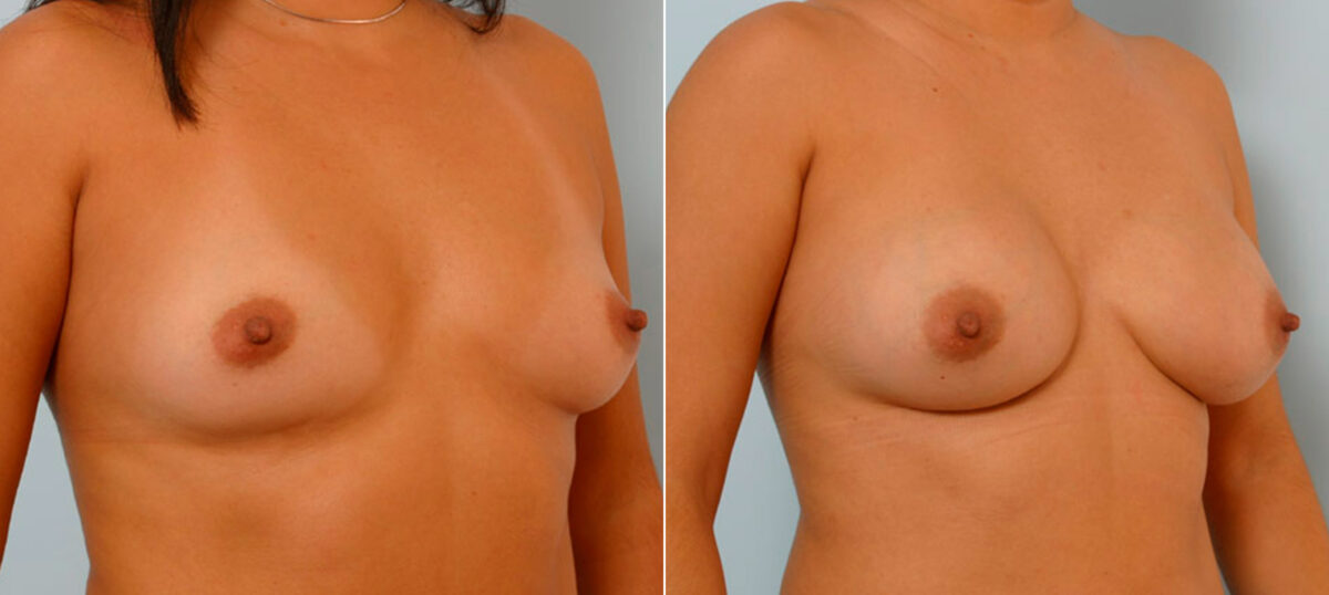 Breast Augmentation before and after photos in Houston, TX, Patient 25663