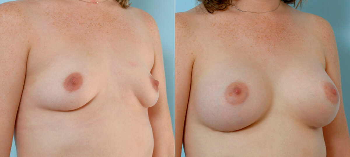 Breast Augmentation before and after photos in Houston, TX, Patient 25670