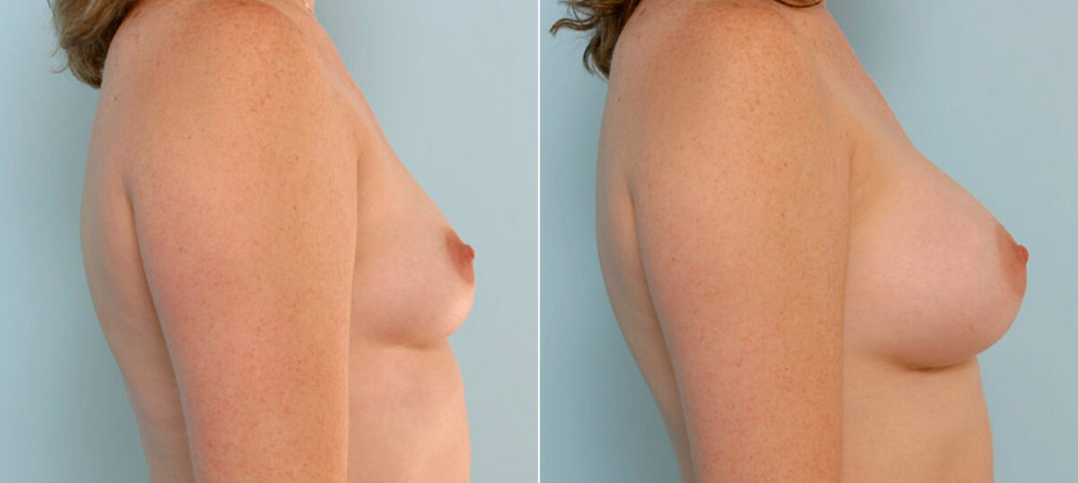 Breast Augmentation before and after photos in Houston, TX, Patient 25670