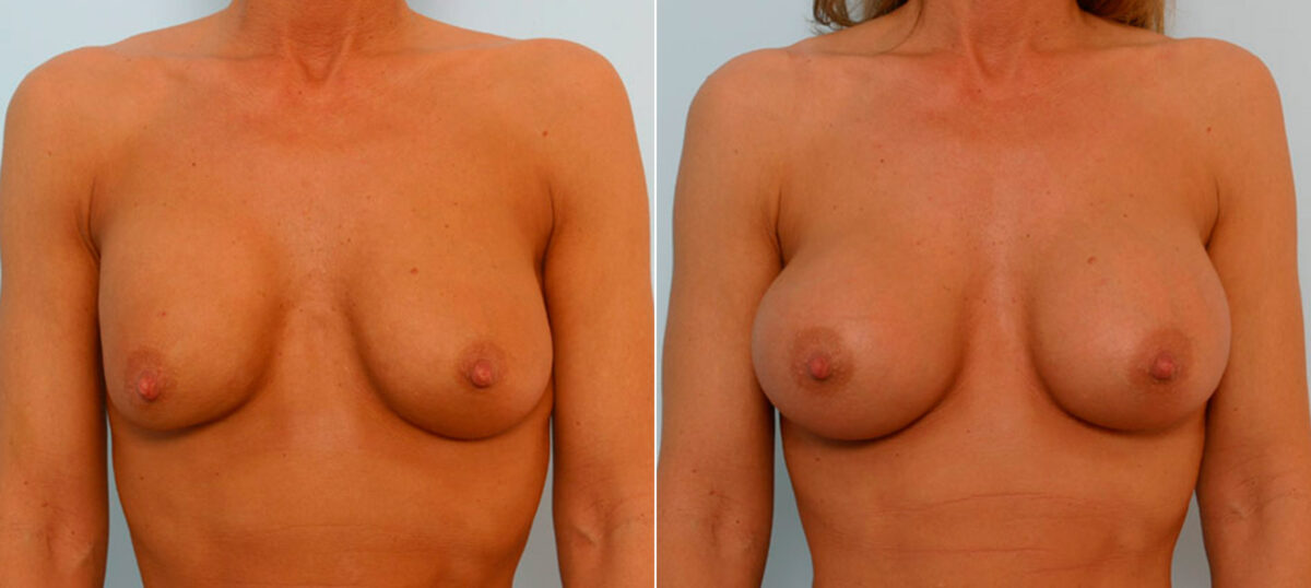 Breast Augmentation before and after photos in Houston, TX, Patient 25677
