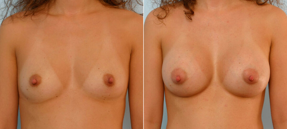 Breast Augmentation before and after photos in Houston, TX, Patient 25684
