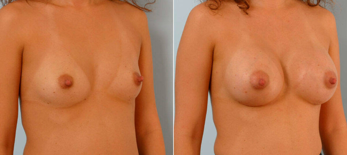 Breast Augmentation before and after photos in Houston, TX, Patient 25684