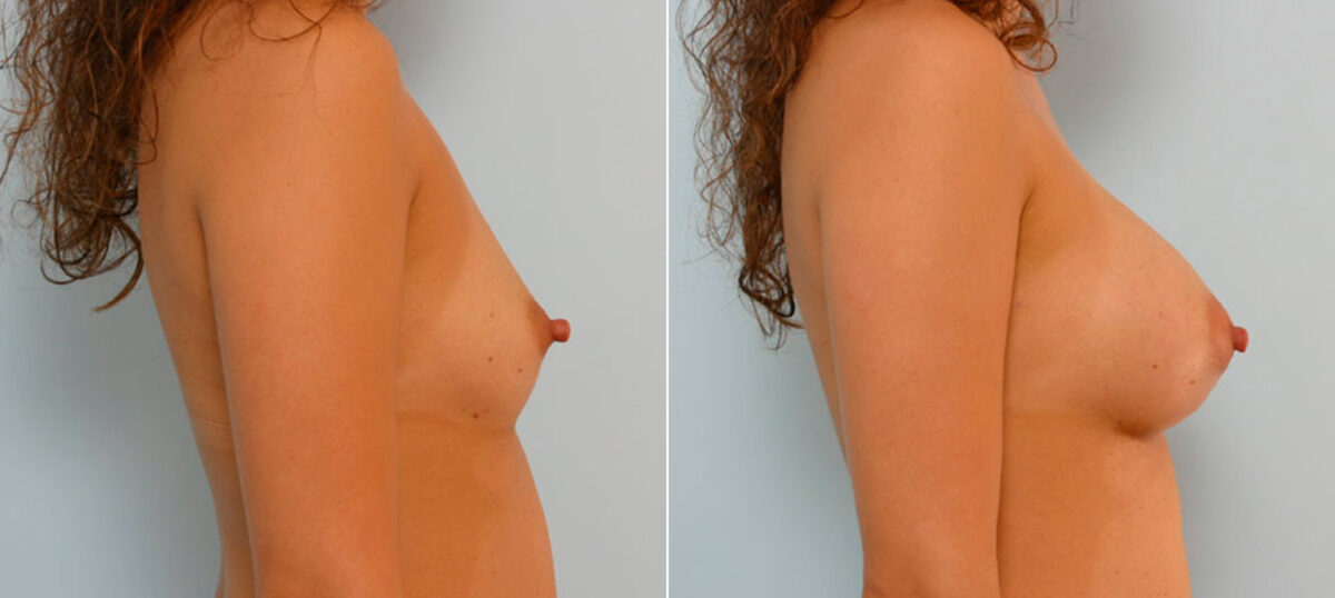 Breast Augmentation before and after photos in Houston, TX, Patient 25684