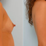 Breast Augmentation before and after photos in Houston, TX, Patient 25684