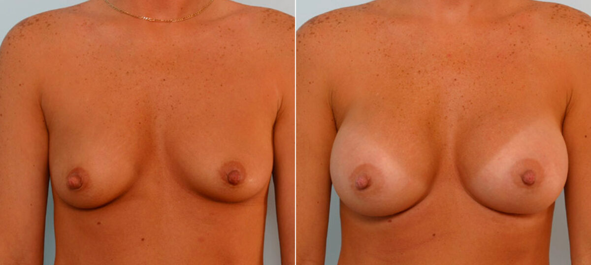 Breast Augmentation before and after photos in Houston, TX, Patient 25691