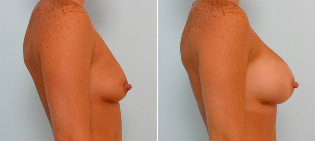 Breast Augmentation before and after photos in Houston, TX, Patient 25691