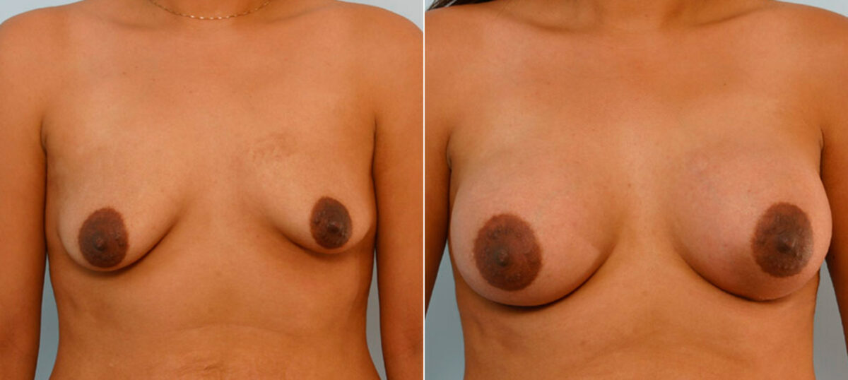 Breast Augmentation before and after photos in Houston, TX, Patient 25698