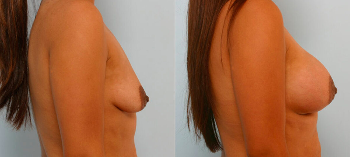 Breast Augmentation before and after photos in Houston, TX, Patient 25698