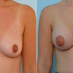 Breast Augmentation before and after photos in Houston, TX, Patient 25705