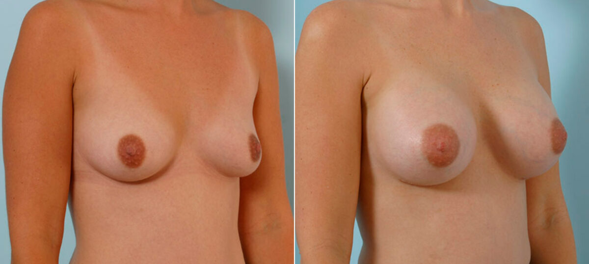 Breast Augmentation before and after photos in Houston, TX, Patient 25705