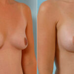 Breast Augmentation before and after photos in Houston, TX, Patient 25705