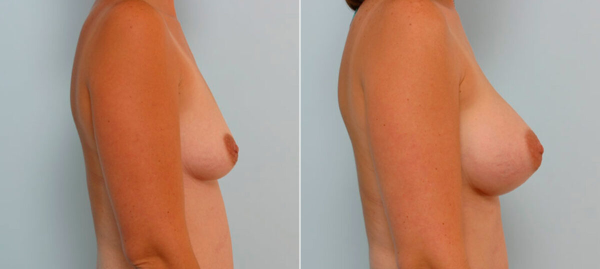 Breast Augmentation before and after photos in Houston, TX, Patient 25705