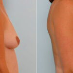 Breast Augmentation before and after photos in Houston, TX, Patient 25705