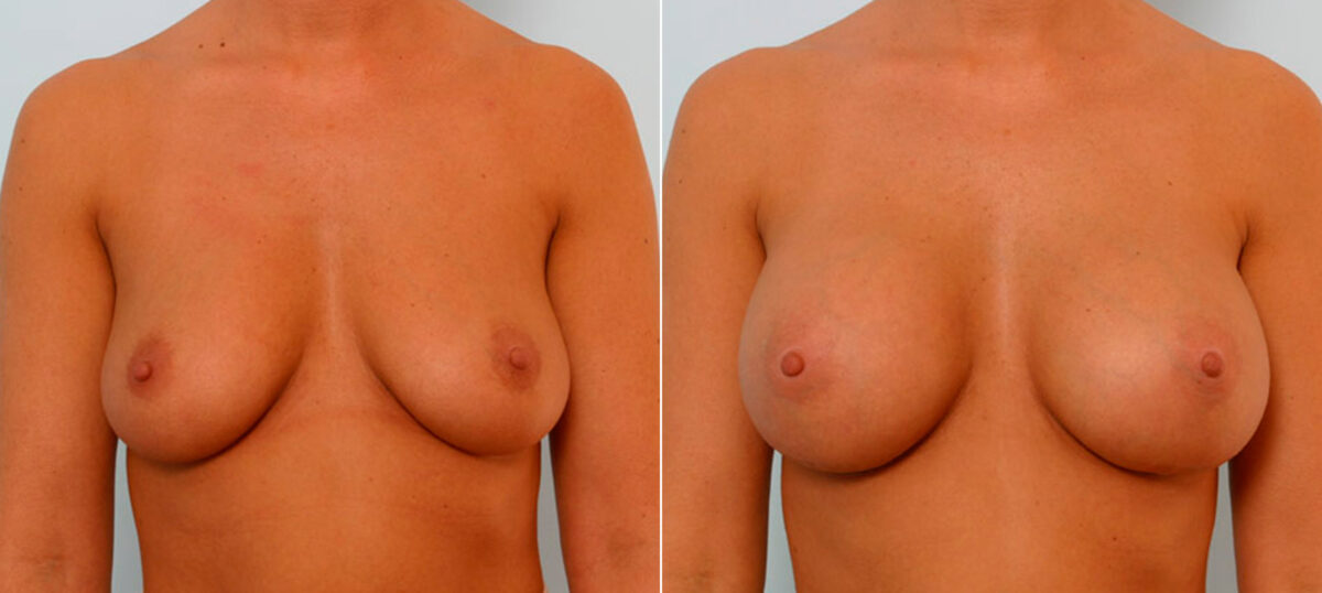 Breast Augmentation before and after photos in Houston, TX, Patient 25712