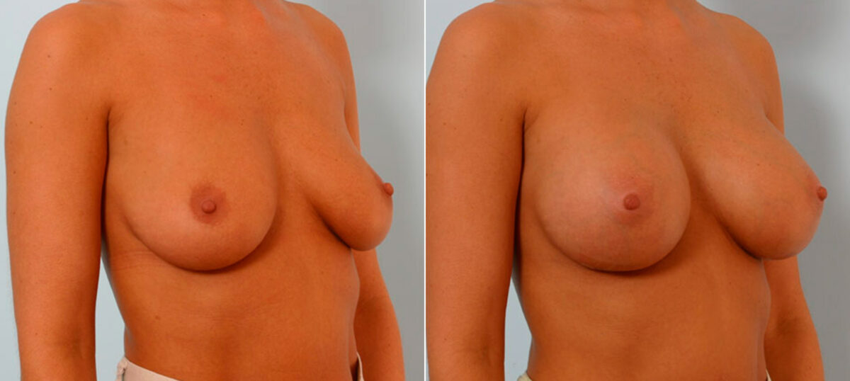 Breast Augmentation before and after photos in Houston, TX, Patient 25712