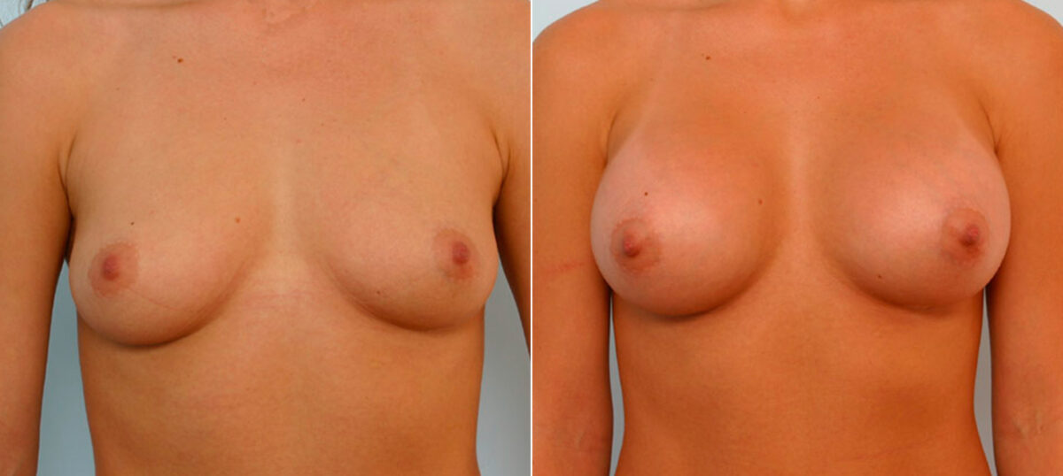 Breast Augmentation before and after photos in Houston, TX, Patient 25719