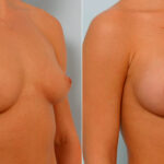 Breast Augmentation before and after photos in Houston, TX, Patient 25719