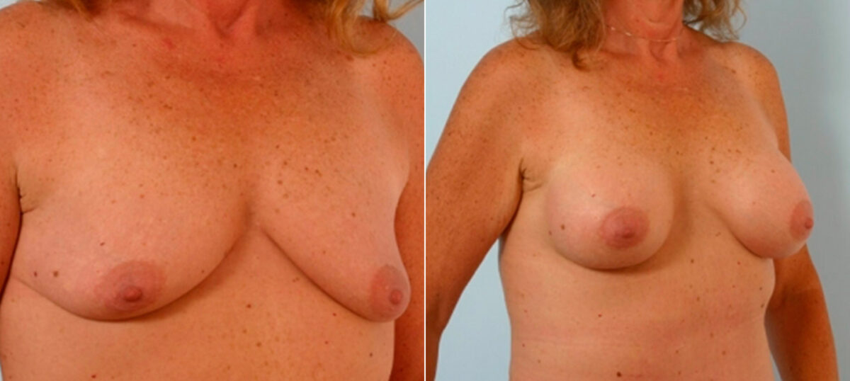 Breast Augmentation before and after photos in Houston, TX, Patient 25726
