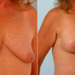 Breast Augmentation before and after photos in Houston, TX, Patient 25726