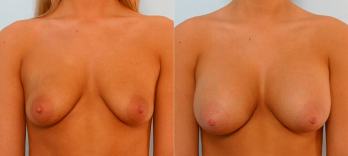Breast Augmentation before and after photos in Houston, TX, Patient 25733