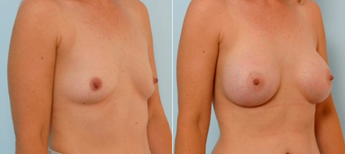 Breast Augmentation before and after photos in Houston, TX, Patient 25740