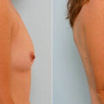 Breast Augmentation before and after photos in Houston, TX, Patient 25740