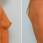 Breast Augmentation before and after photos in Houston, TX, Patient 25747
