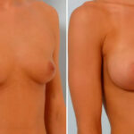 Breast Augmentation before and after photos in Houston, TX, Patient 25747