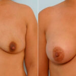 Breast Augmentation before and after photos in Houston, TX, Patient 25754