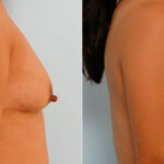 Breast Augmentation before and after photos in Houston, TX, Patient 25754