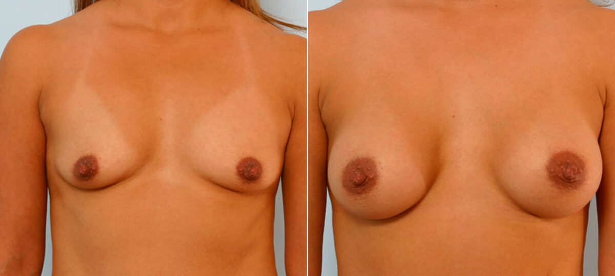 Breast Augmentation before and after photos in Houston, TX, Patient 25761