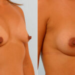Breast Augmentation before and after photos in Houston, TX, Patient 25761