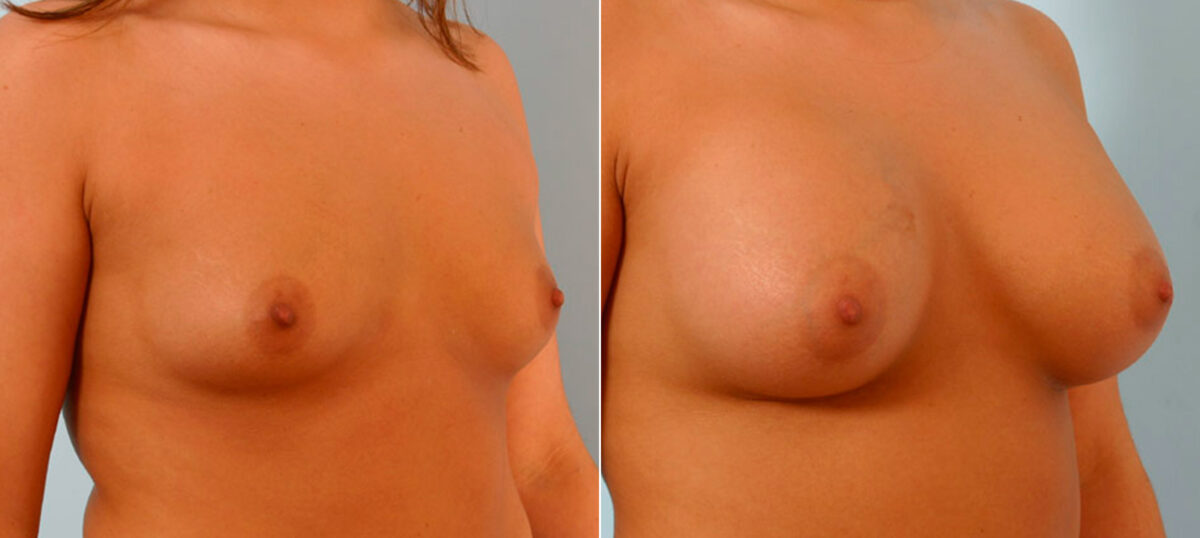 Breast Augmentation before and after photos in Houston, TX, Patient 25768