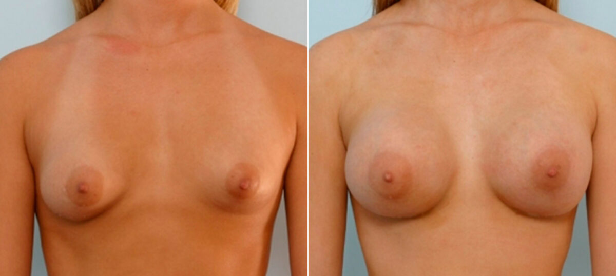 Breast Augmentation before and after photos in Houston, TX, Patient 25775