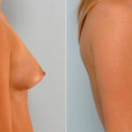 Breast Augmentation before and after photos in Houston, TX, Patient 25775