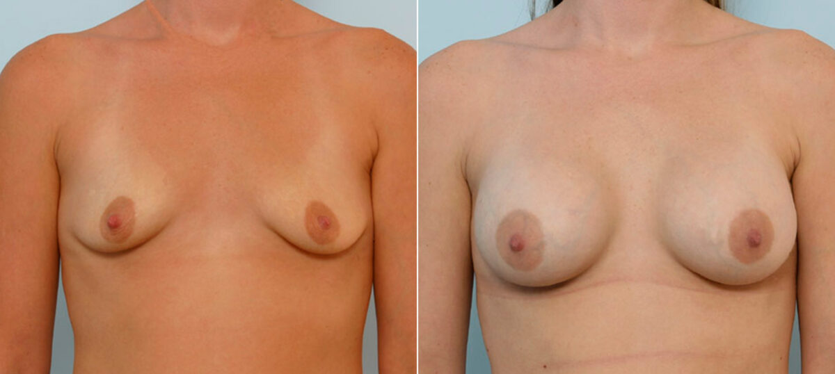 Breast Augmentation before and after photos in Houston, TX, Patient 25782