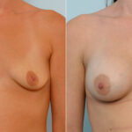 Breast Augmentation before and after photos in Houston, TX, Patient 25782