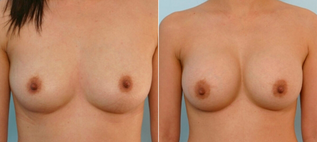 Breast Augmentation before and after photos in Houston, TX, Patient 25789