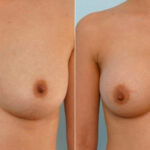 Breast Augmentation before and after photos in Houston, TX, Patient 25789