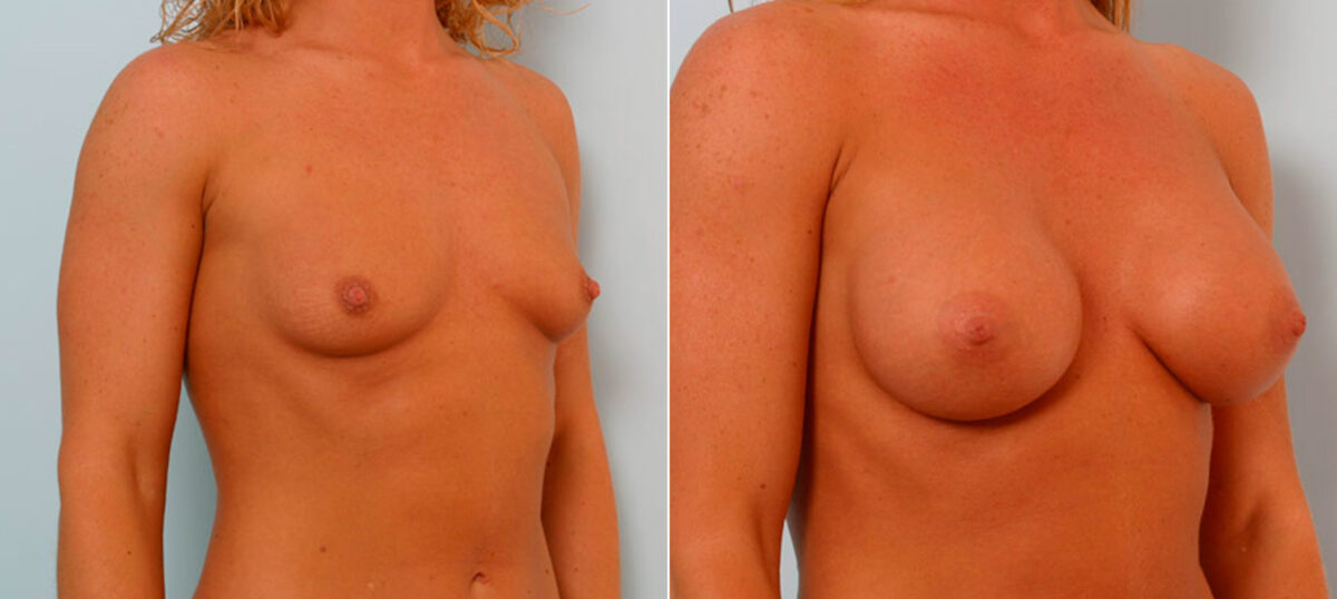 Breast Augmentation before and after photos in Houston, TX, Patient 25796