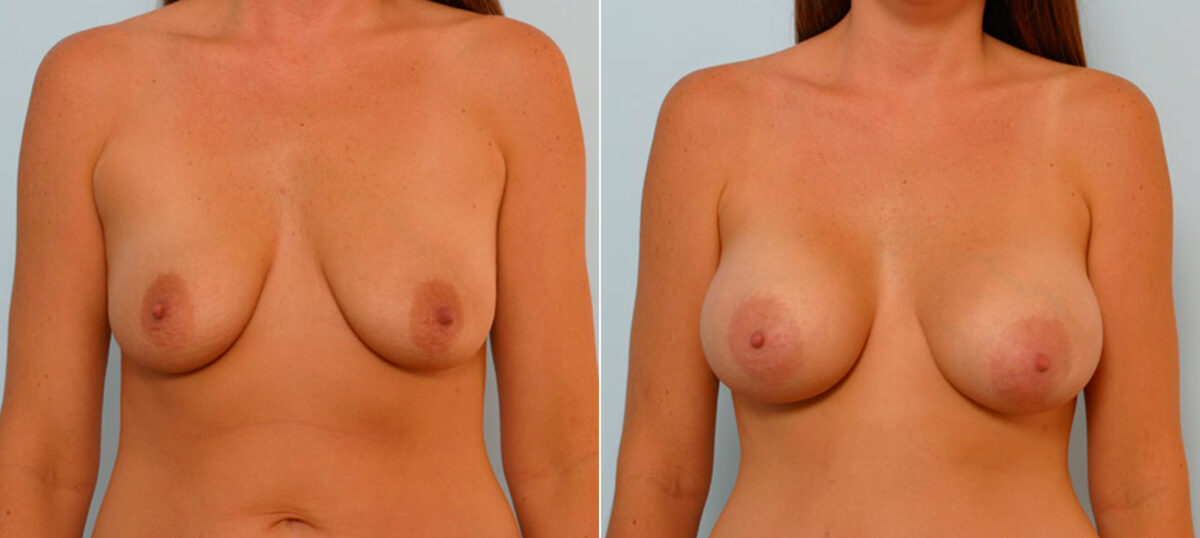 Breast Augmentation before and after photos in Houston, TX, Patient 25803