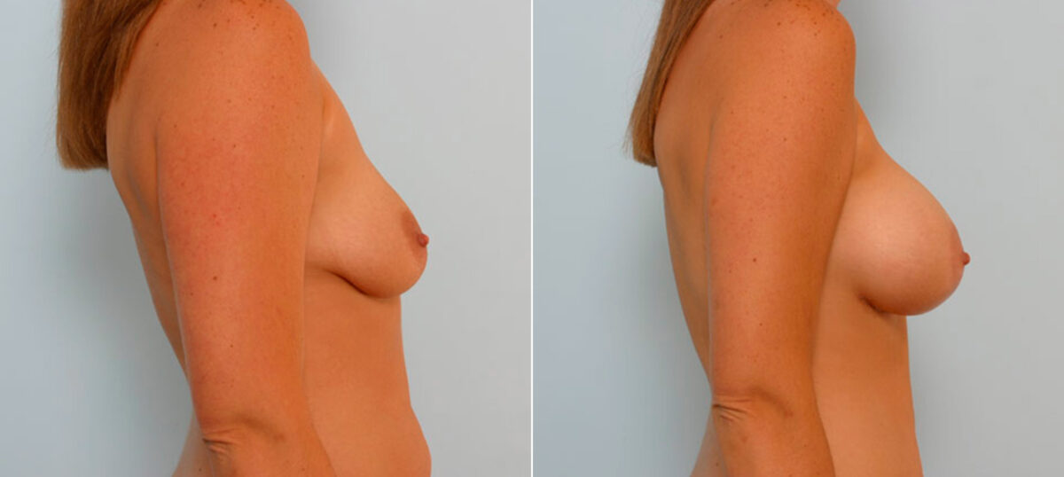 Breast Augmentation before and after photos in Houston, TX, Patient 25803