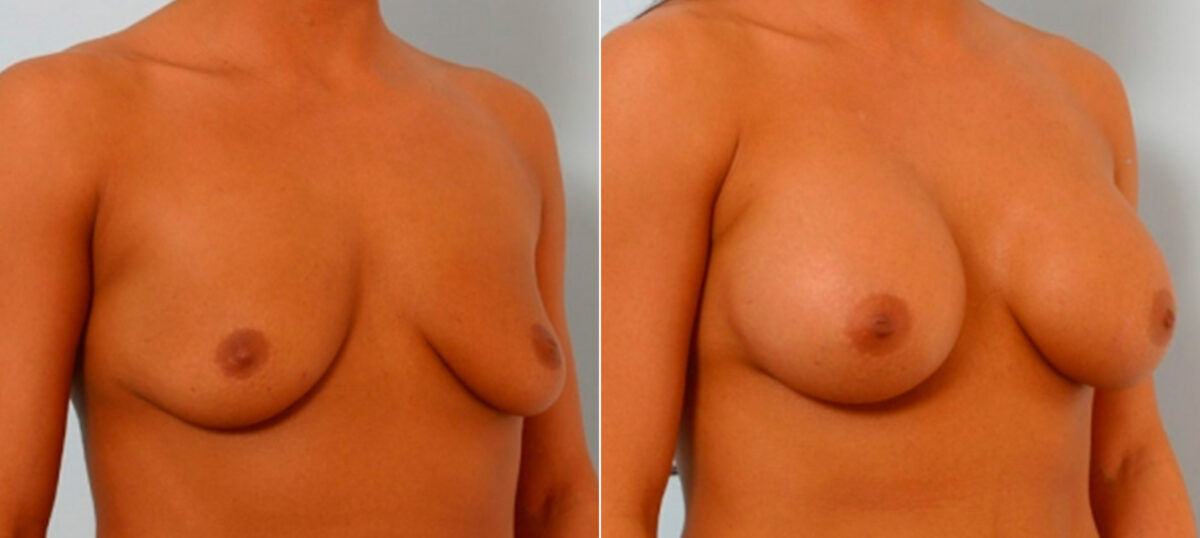 Breast Augmentation before and after photos in Houston, TX, Patient 25810
