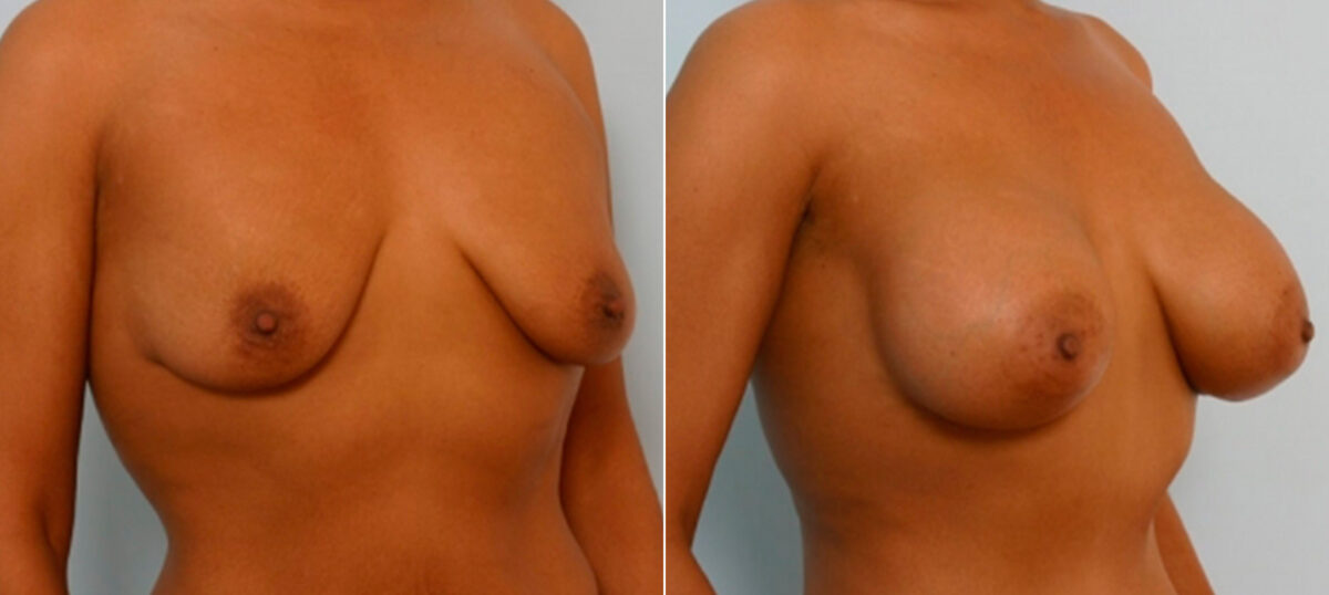 Breast Augmentation before and after photos in Houston, TX, Patient 25817