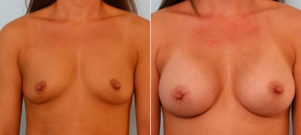 Breast Augmentation before and after photos in Houston, TX, Patient 25824