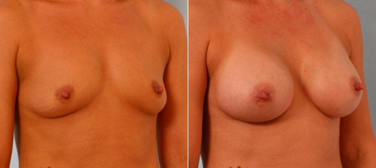 Breast Augmentation before and after photos in Houston, TX, Patient 25824