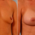 Breast Augmentation before and after photos in Houston, TX, Patient 25824